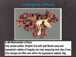 Cryptogenic cirrhosis
 