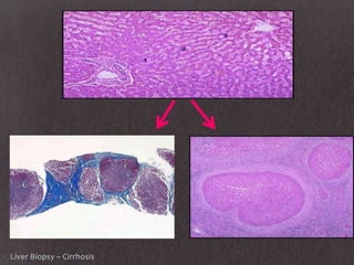 • Liver Biopsy – Cirrhosis
 