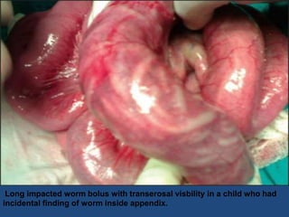 Long impacted worm bolus with transerosal visbility in a child who had
incidental finding of worm inside appendix.
 