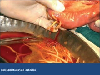 Appendiceal ascariasis in children
 