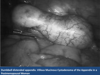 Figure 1: Dumbbell distended appendix.




Dumbbell distended appendix. Villous Mucinous Cystadenoma of the Appendix in a
Postmenopausal Woman
 