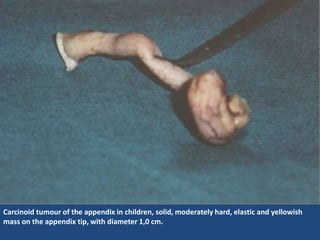 Carcinoid tumour of the appendix in children, solid, moderately hard, elastic and yellowish
mass on the appendix tip, with diameter 1,0 cm.
 