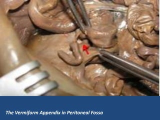 The Vermiform Appendix in Peritoneal Fossa
 