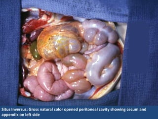 Situs Inversus: Gross natural color opened peritoneal cavity showing cecum and
appendix on left side
 