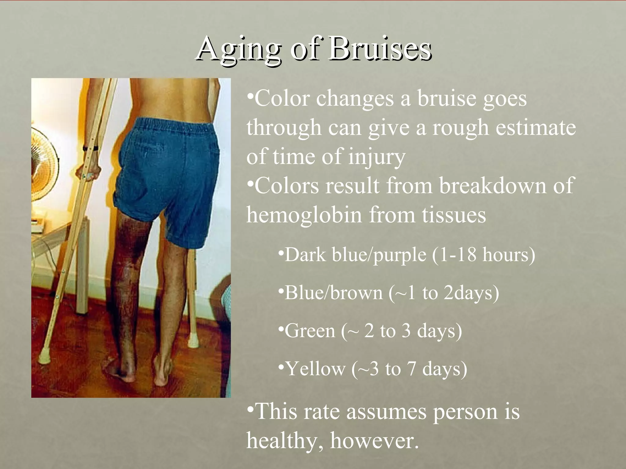 Aging of Bruises
   •Color changes a bruise goes
   through can give a rough estimate
   of time of injury
   •Colors result from breakdown of
   hemoglobin from tissues
      •Dark blue/purple (1-18 hours)
      •Blue/brown (~1 to 2days)
      •Green (~ 2 to 3 days)
      •Yellow (~3 to 7 days)

   •This rate assumes person is
   healthy, however.
 