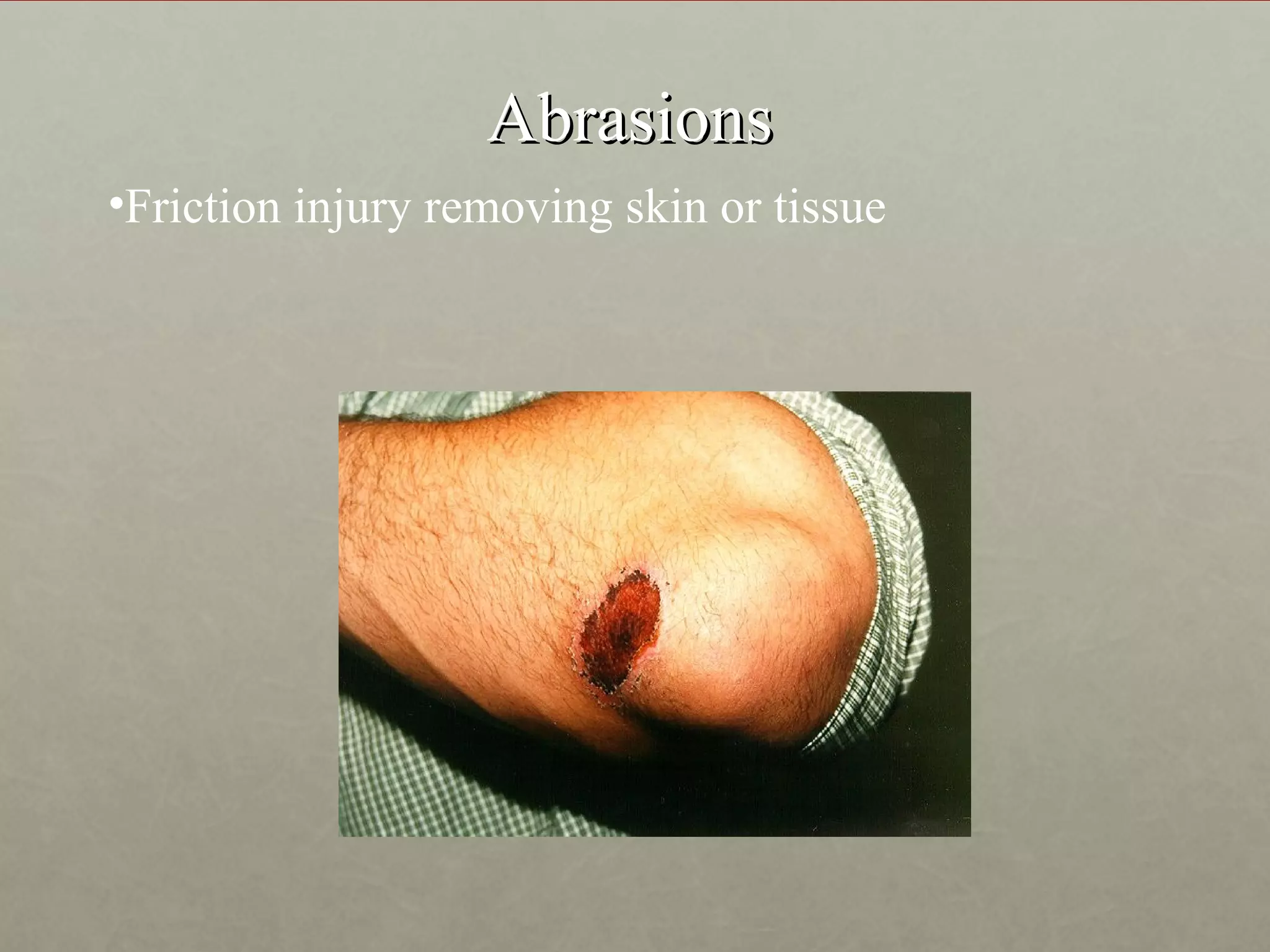 Abrasions
•Friction injury removing skin or tissue
 