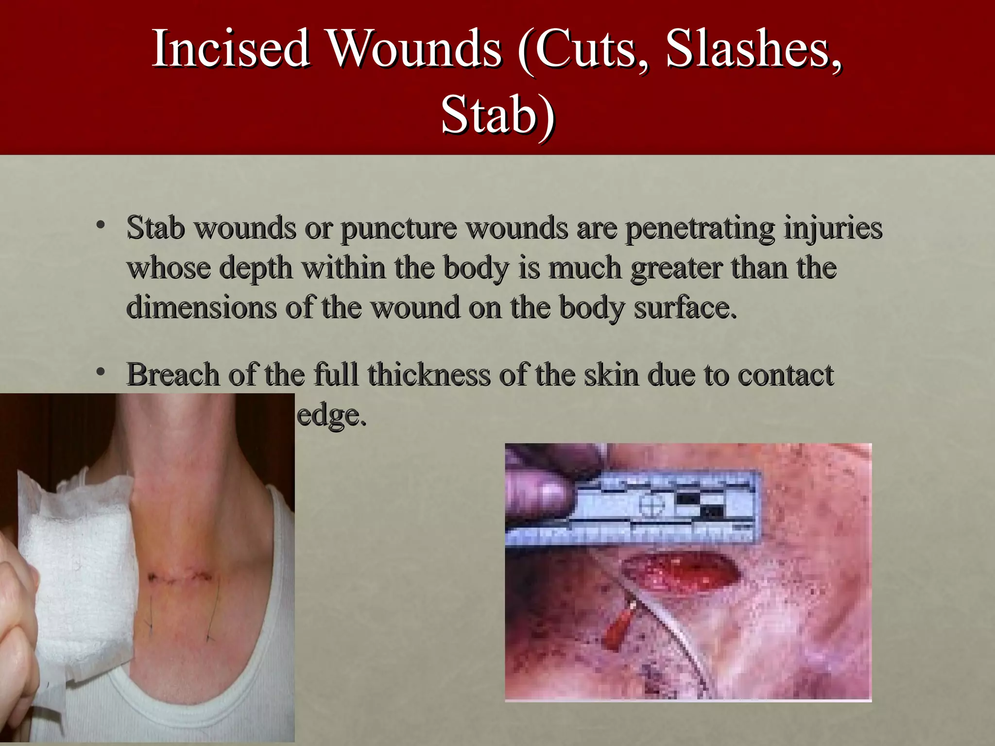 Incised Wounds (Cuts, Slashes,
               Stab)
• Stab wounds or puncture wounds are penetrating injuries
  whose depth within the body is much greater than the
  dimensions of the wound on the body surface.
• Breach of the full thickness of the skin due to contact
  with a sharp edge.
 