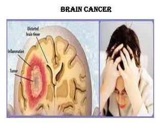 Brain cancer
 