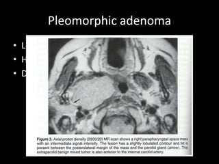 Pleomorphic adenoma
• Low signal intensity on T1
• High signal intensity on T2
• Displace carotid posteriorly
 