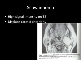 Schwannoma
• High signal intensity on T2
• Displace carotid anteriorly
 