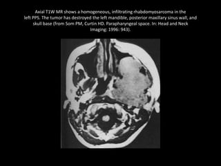 Axial T1W MR shows a homogeneous, infiltrating rhabdomyosarcoma in the
left PPS. The tumor has destroyed the left mandible, posterior maxillary sinus wall, and
skull base (from Som PM, Curtin HD. Parapharyngeal space. In: Head and Neck
Imaging: 1996: 943).
 