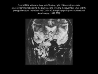 Coronal T2W MR scans show an infiltrating right PPS tumor (metastatic
renal cell carcinoma) eroding the skull base and invading the cavernous sinus and the
pterygoid muscles (from Som PM, Curtin HD. Parapharyngeal space. In: Head and
Neck Imaging: 1996: 937).
 