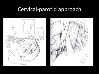 Cervical-parotid approach
 