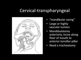 Cervical-transpharyngeal
• “mandibular swing”
• Large or highly
vascular tumors
• Mandibulotomy
anteriorly, incise along
floor of mouth to
anterior tonsillar pillar
• Need a tracheotomy
 