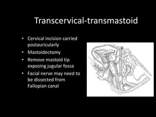 Transcervical-transmastoid
• Cervical incision carried
postauricularly
• Mastoidectomy
• Remove mastoid tip
exposing jugular fossa
• Facial nerve may need to
be dissected from
Fallopian canal
 