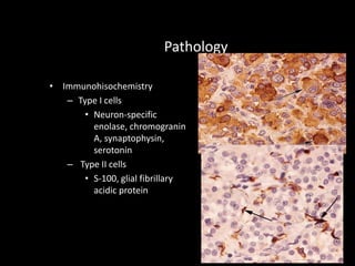 Pathology
• Immunohisochemistry
– Type I cells
• Neuron-specific
enolase, chromogranin
A, synaptophysin,
serotonin
– Type II cells
• S-100, glial fibrillary
acidic protein
 
