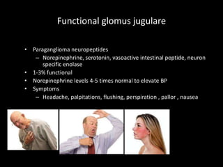 Functional glomus jugulare
• Paraganglioma neuropeptides
– Norepinephrine, serotonin, vasoactive intestinal peptide, neuron
specific enolase
• 1-3% functional
• Norepinephrine levels 4-5 times normal to elevate BP
• Symptoms
– Headache, palpitations, flushing, perspiration , pallor , nausea
 