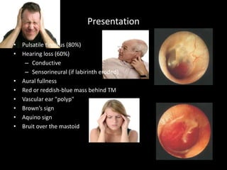 Presentation
• Pulsatile tinnitus (80%)
• Hearing loss (60%)
– Conductive
– Sensorineural (if labirinth eroded)
• Aural fullness
• Red or reddish-blue mass behind TM
• Vascular ear "polyp"
• Brown’s sign
• Aquino sign
• Bruit over the mastoid
 