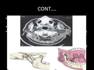 CONT….
• (node of Rouvière, 1927)- draining the
nasopharynx, upper oropharynx and sinuses.
• Lincoln's highway.
• Patey and Thackray (1956-157) coined the term
'stylomandibular tunnel' formed by the posterior
margin of the ascending ramus of the mandible
anteriorly, the styloid process and
stylomandibular ligament behind and the base of
the skull above. This tunnel resists pressure so
that tumours of the deep lobe of the parotid
gland assume a dumb-bell shape as they grow
 