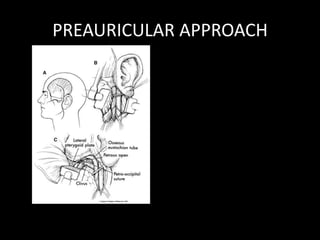 PREAURICULAR APPROACH
 