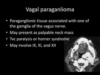 Vagal paraganlioma
• Paraganglionic tissue associated with one of
the gamglia of the vagus nerve.
• May present as palpable neck mass
• Tvc paralysis or horner syndrome
• May involve IX, XI, and XII
 