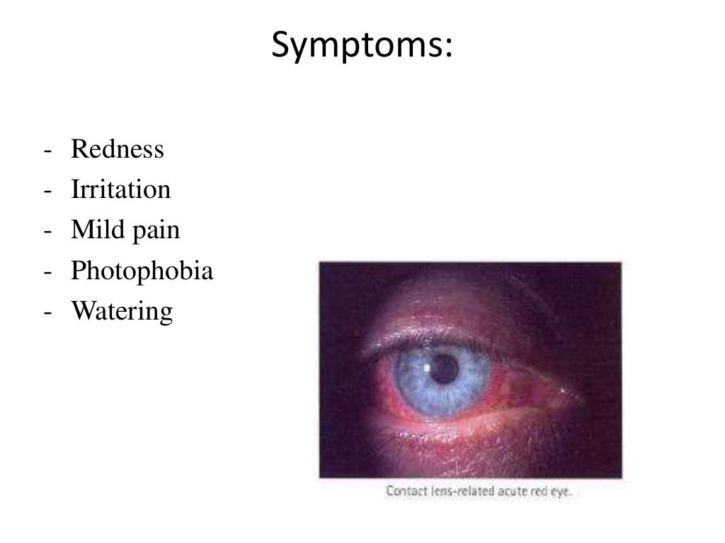Contact LensInduced Acute Red Eye(CLARE)