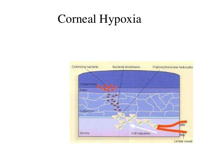 Contact Lens-Induced Acute Red Eye(CLARE)