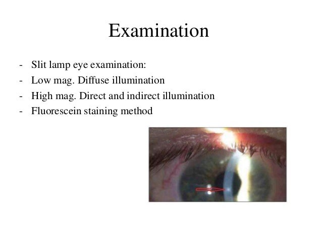 Contact Lens-Induced Acute Red Eye(CLARE)