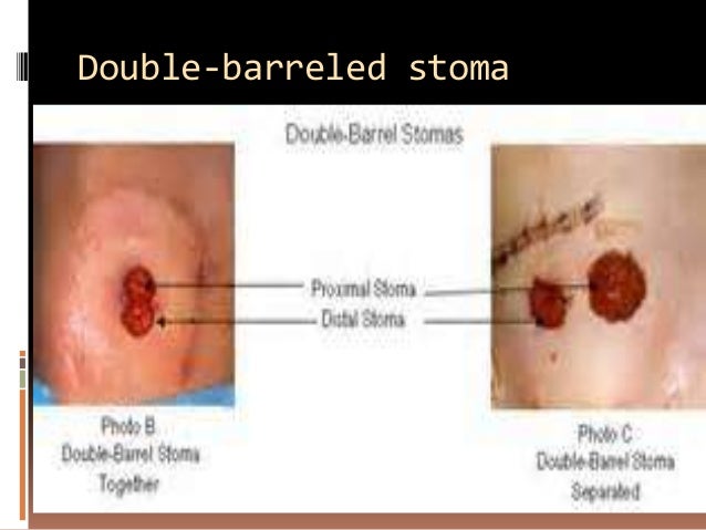 Body image and stoma health and social care essay 05 picture