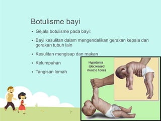 Botulisme bayi


Gejala botulisme pada bayi:



Bayi kesulitan dalam mengendalikan gerakan kepala dan
gerakan tubuh lain



Kesulitan mengisap dan makan



Kelumpuhan



Tangisan lemah

 