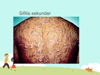 Sifilis sekunder

 