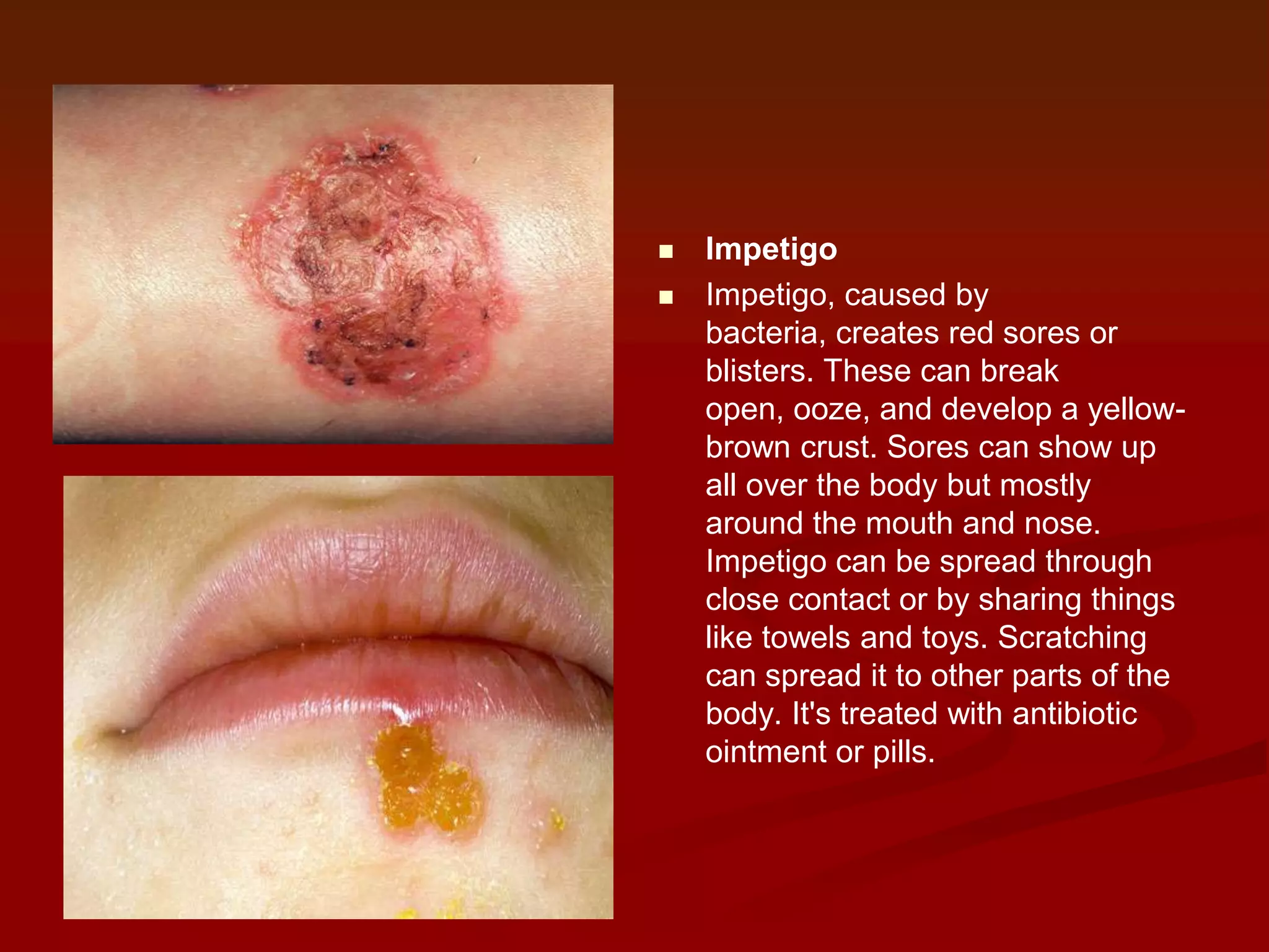 


Impetigo
Impetigo, caused by
bacteria, creates red sores or
blisters. These can break
open, ooze, and develop a yellowbrown crust. Sores can show up
all over the body but mostly
around the mouth and nose.
Impetigo can be spread through
close contact or by sharing things
like towels and toys. Scratching
can spread it to other parts of the
body. It's treated with antibiotic
ointment or pills.

 