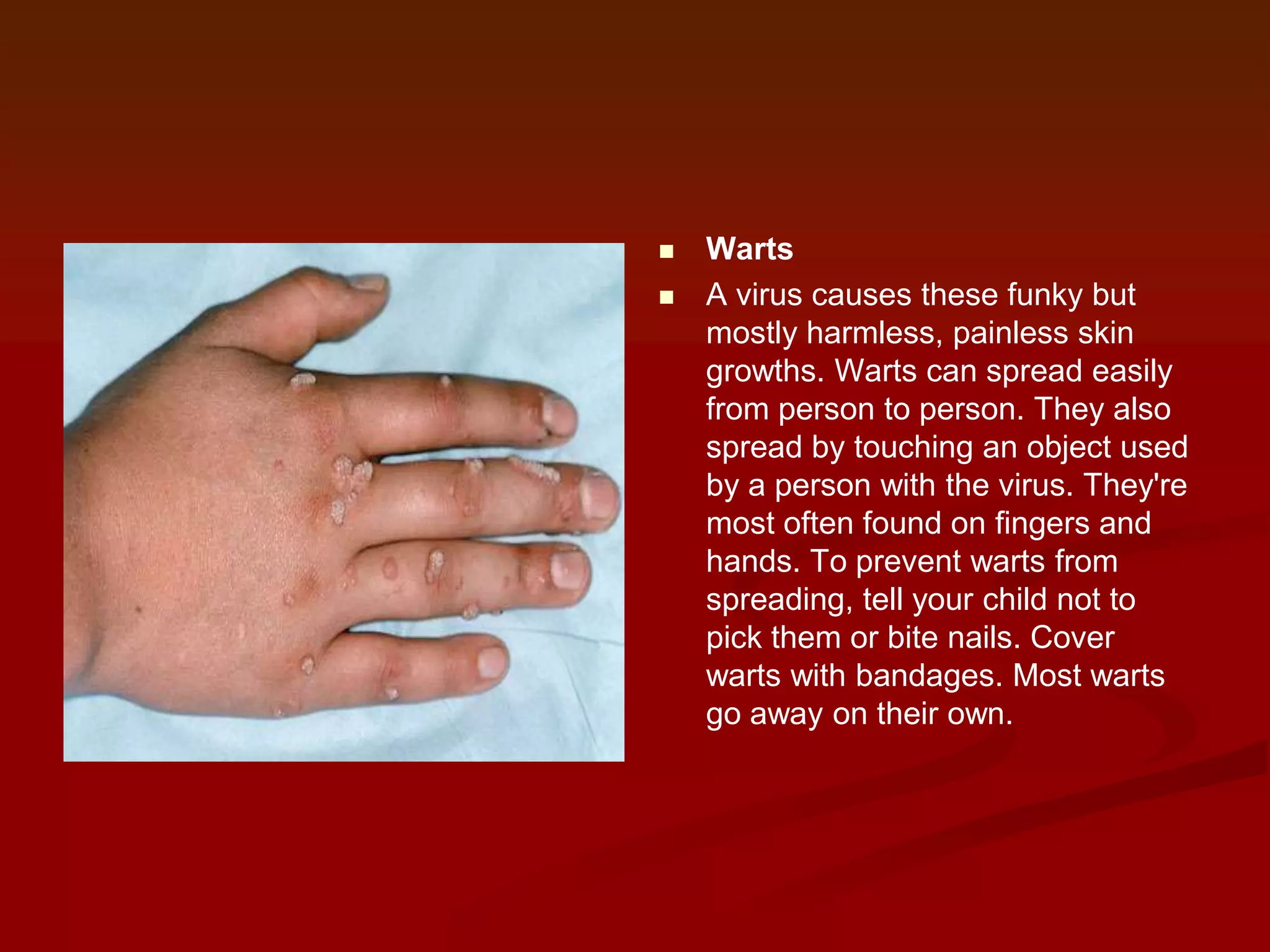 


Warts
A virus causes these funky but
mostly harmless, painless skin
growths. Warts can spread easily
from person to person. They also
spread by touching an object used
by a person with the virus. They're
most often found on fingers and
hands. To prevent warts from
spreading, tell your child not to
pick them or bite nails. Cover
warts with bandages. Most warts
go away on their own.

 