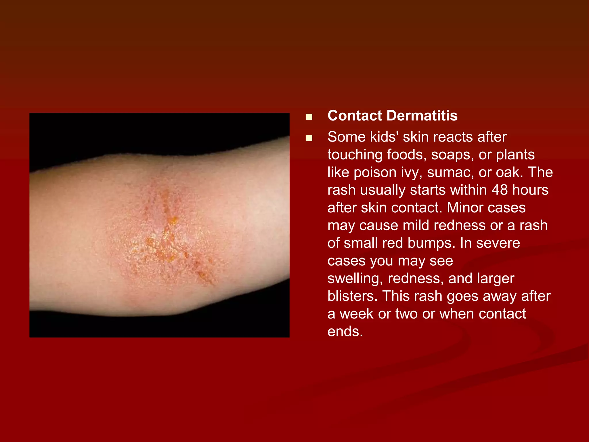 


Contact Dermatitis
Some kids' skin reacts after
touching foods, soaps, or plants
like poison ivy, sumac, or oak. The
rash usually starts within 48 hours
after skin contact. Minor cases
may cause mild redness or a rash
of small red bumps. In severe
cases you may see
swelling, redness, and larger
blisters. This rash goes away after
a week or two or when contact
ends.

 