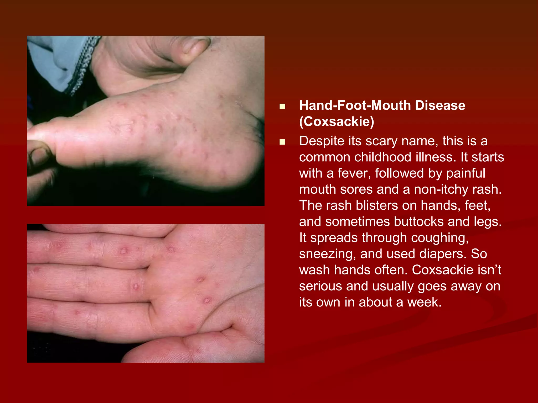 



Hand-Foot-Mouth Disease
(Coxsackie)
Despite its scary name, this is a
common childhood illness. It starts
with a fever, followed by painful
mouth sores and a non-itchy rash.
The rash blisters on hands, feet,
and sometimes buttocks and legs.
It spreads through coughing,
sneezing, and used diapers. So
wash hands often. Coxsackie isn’t
serious and usually goes away on
its own in about a week.

 