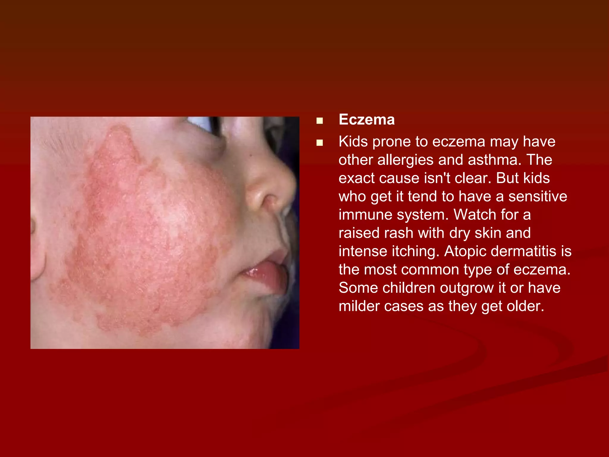 


Eczema
Kids prone to eczema may have
other allergies and asthma. The
exact cause isn't clear. But kids
who get it tend to have a sensitive
immune system. Watch for a
raised rash with dry skin and
intense itching. Atopic dermatitis is
the most common type of eczema.
Some children outgrow it or have
milder cases as they get older.

 