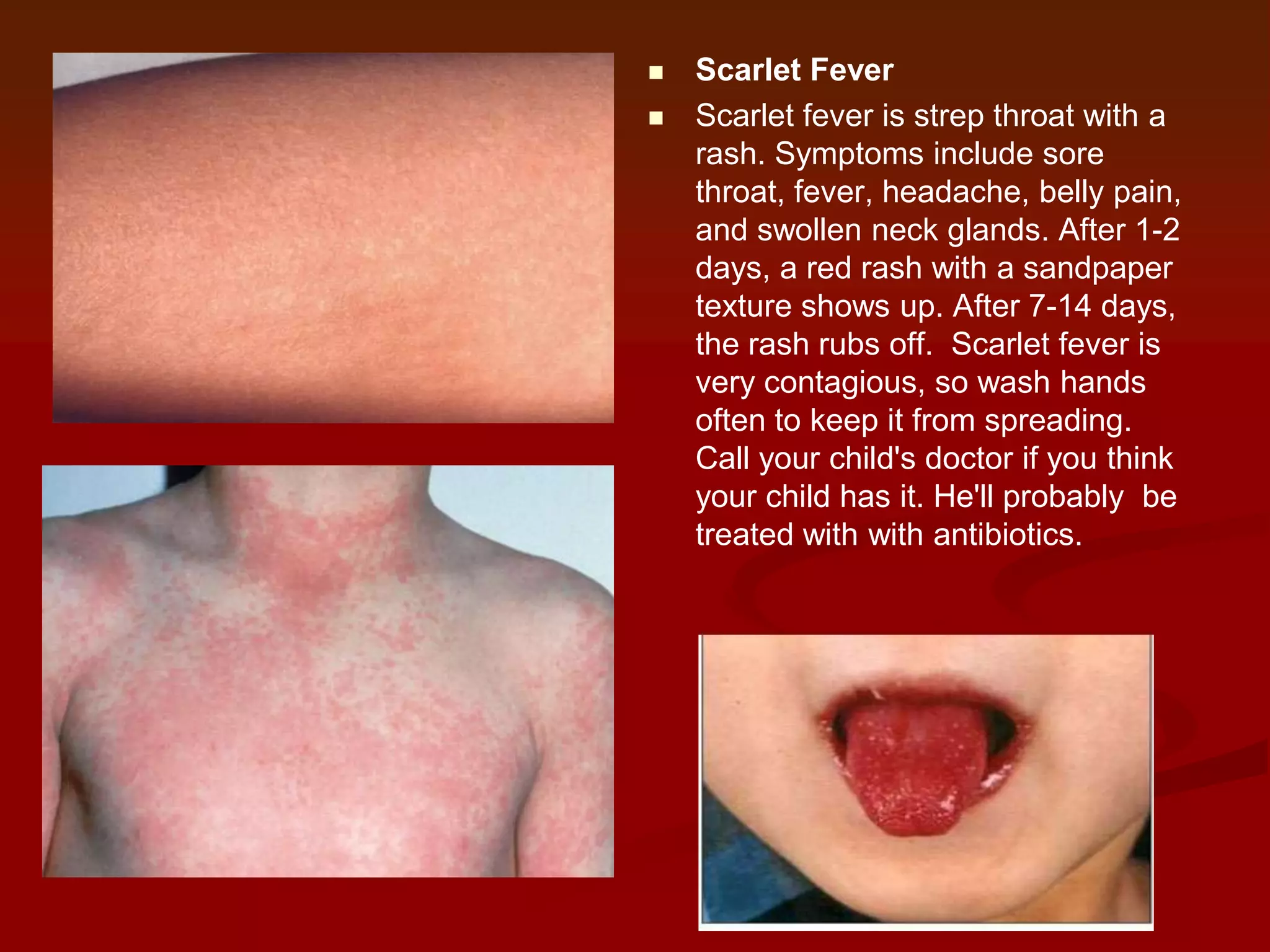 


Scarlet Fever
Scarlet fever is strep throat with a
rash. Symptoms include sore
throat, fever, headache, belly pain,
and swollen neck glands. After 1-2
days, a red rash with a sandpaper
texture shows up. After 7-14 days,
the rash rubs off. Scarlet fever is
very contagious, so wash hands
often to keep it from spreading.
Call your child's doctor if you think
your child has it. He'll probably be
treated with with antibiotics.

 