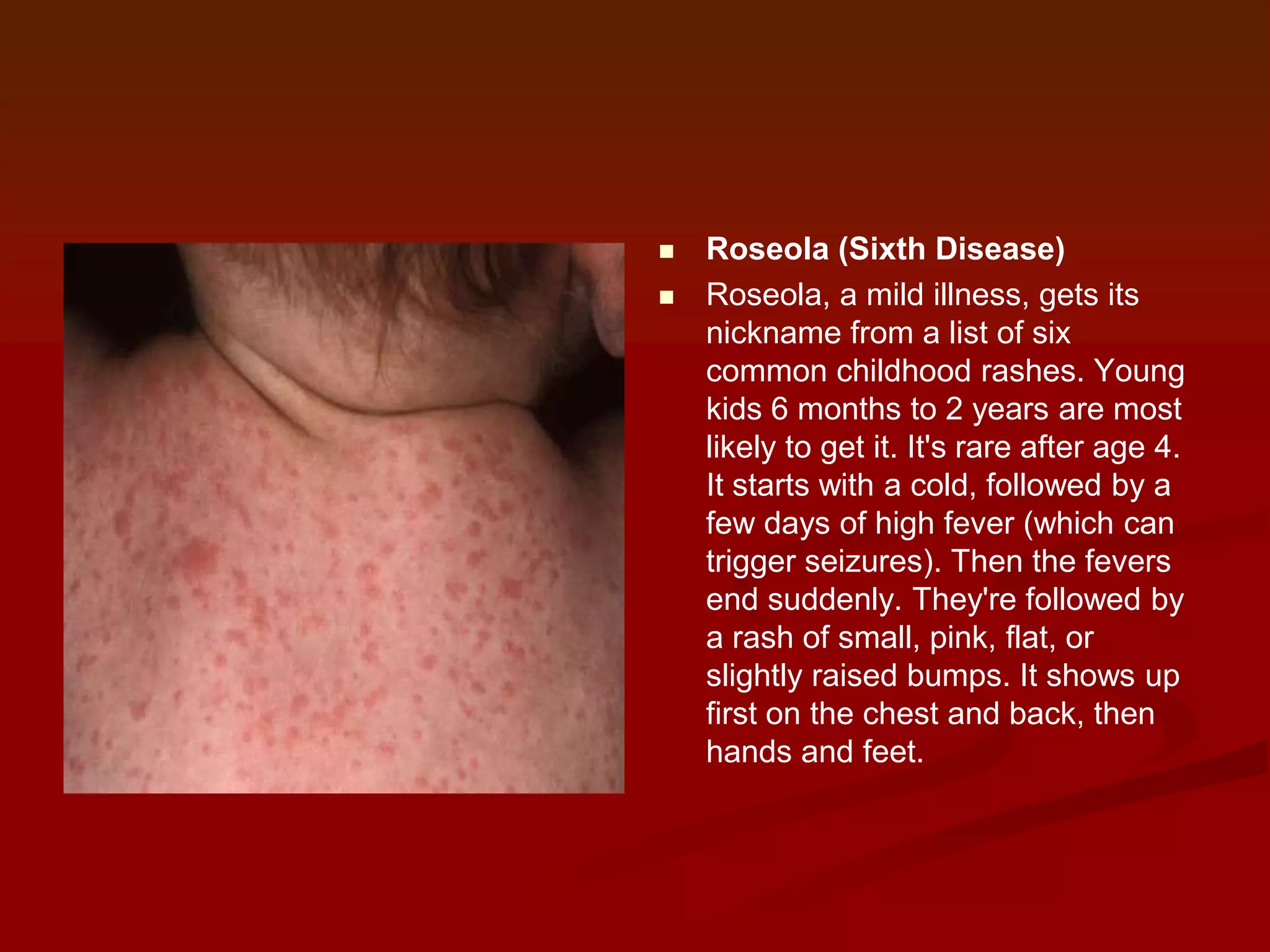 


Roseola (Sixth Disease)
Roseola, a mild illness, gets its
nickname from a list of six
common childhood rashes. Young
kids 6 months to 2 years are most
likely to get it. It's rare after age 4.
It starts with a cold, followed by a
few days of high fever (which can
trigger seizures). Then the fevers
end suddenly. They're followed by
a rash of small, pink, flat, or
slightly raised bumps. It shows up
first on the chest and back, then
hands and feet.

 