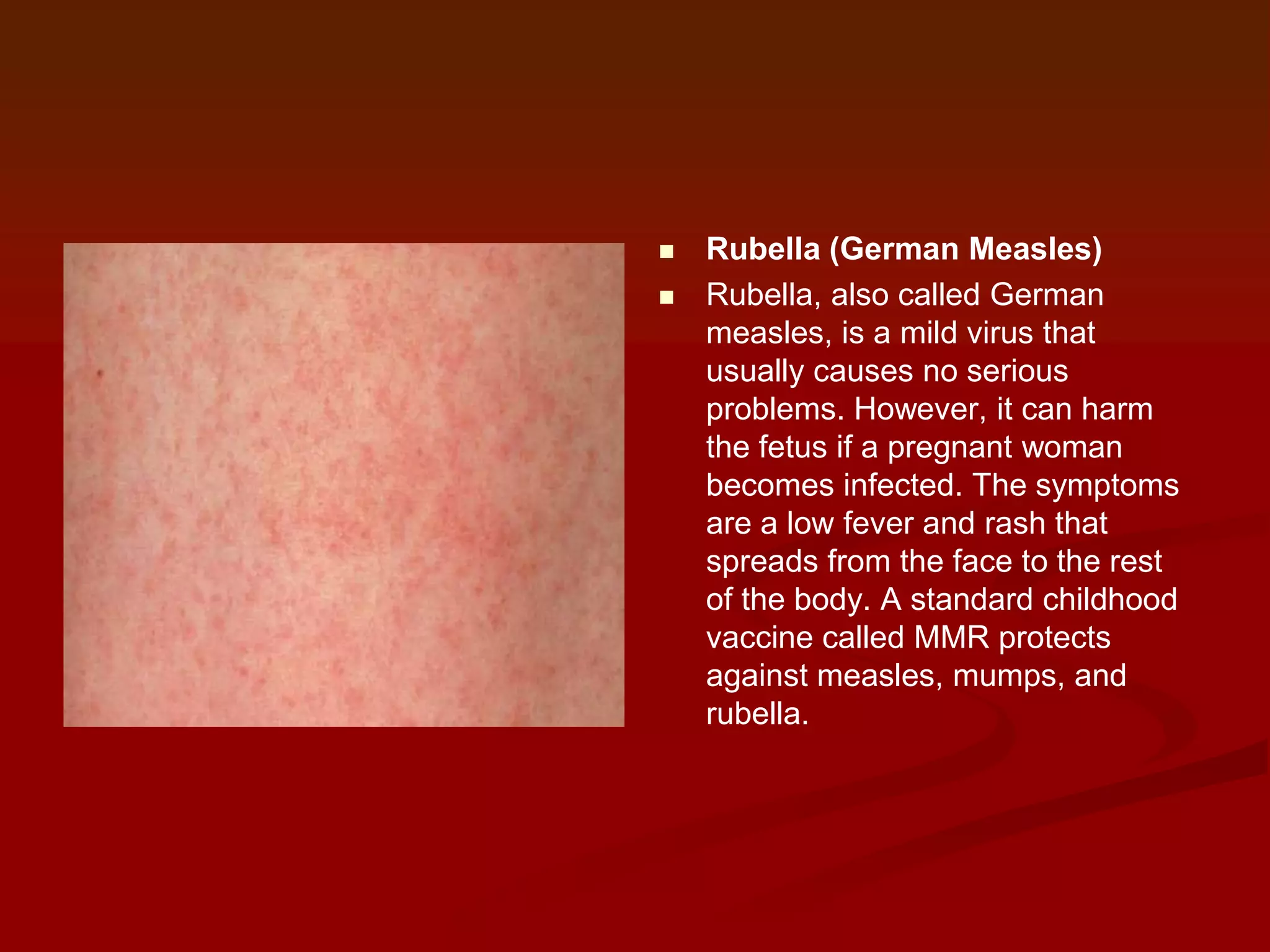 


Rubella (German Measles)
Rubella, also called German
measles, is a mild virus that
usually causes no serious
problems. However, it can harm
the fetus if a pregnant woman
becomes infected. The symptoms
are a low fever and rash that
spreads from the face to the rest
of the body. A standard childhood
vaccine called MMR protects
against measles, mumps, and
rubella.

 