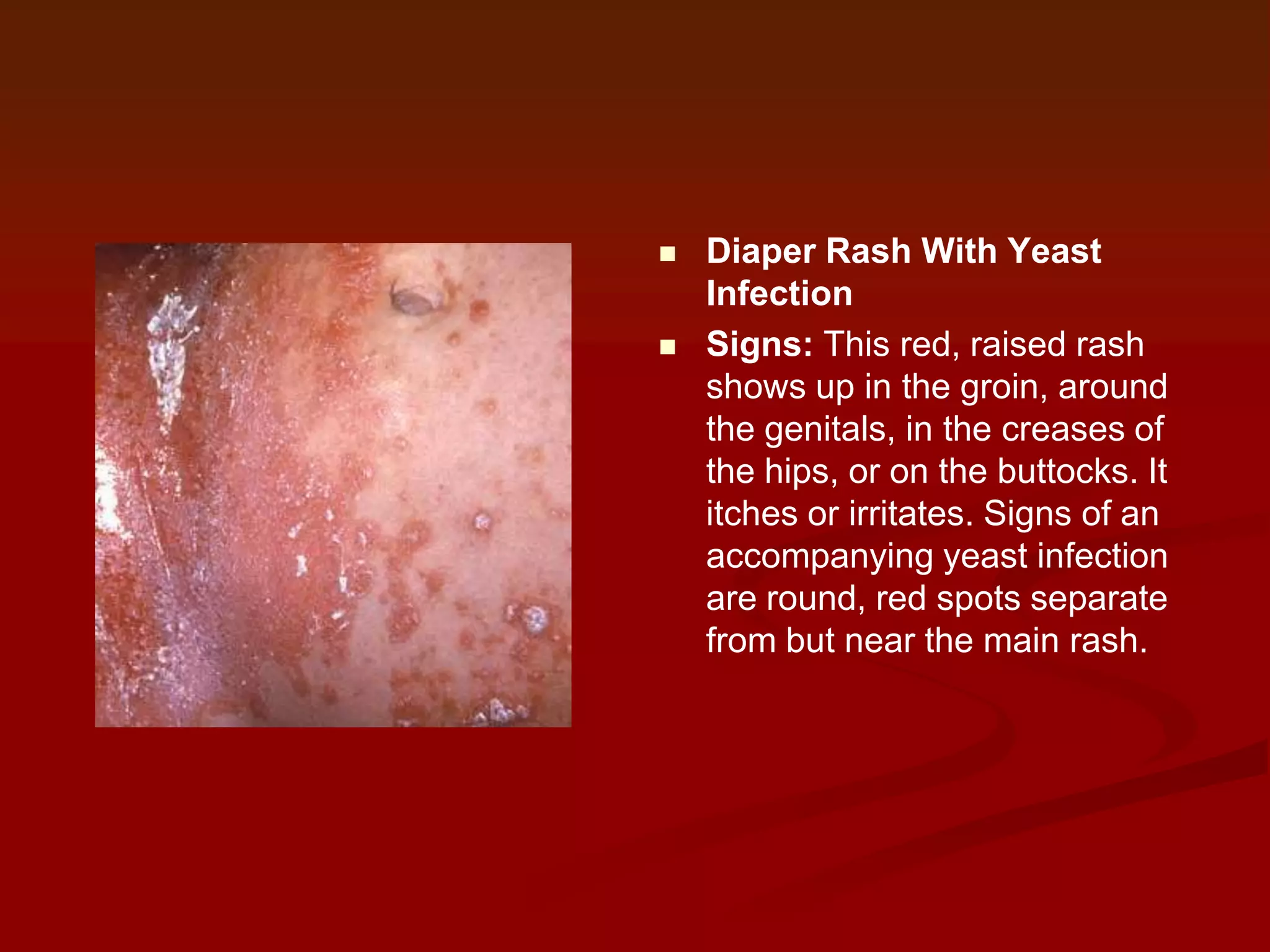 



Diaper Rash With Yeast
Infection
Signs: This red, raised rash
shows up in the groin, around
the genitals, in the creases of
the hips, or on the buttocks. It
itches or irritates. Signs of an
accompanying yeast infection
are round, red spots separate
from but near the main rash.

 