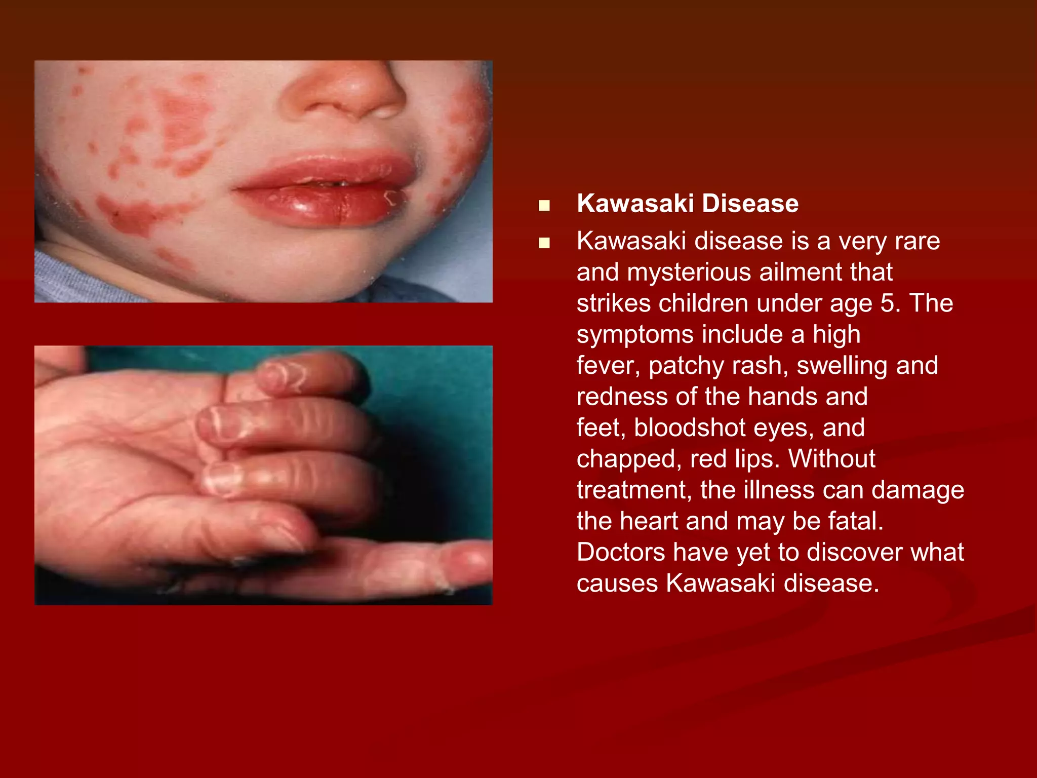 


Kawasaki Disease
Kawasaki disease is a very rare
and mysterious ailment that
strikes children under age 5. The
symptoms include a high
fever, patchy rash, swelling and
redness of the hands and
feet, bloodshot eyes, and
chapped, red lips. Without
treatment, the illness can damage
the heart and may be fatal.
Doctors have yet to discover what
causes Kawasaki disease.

 