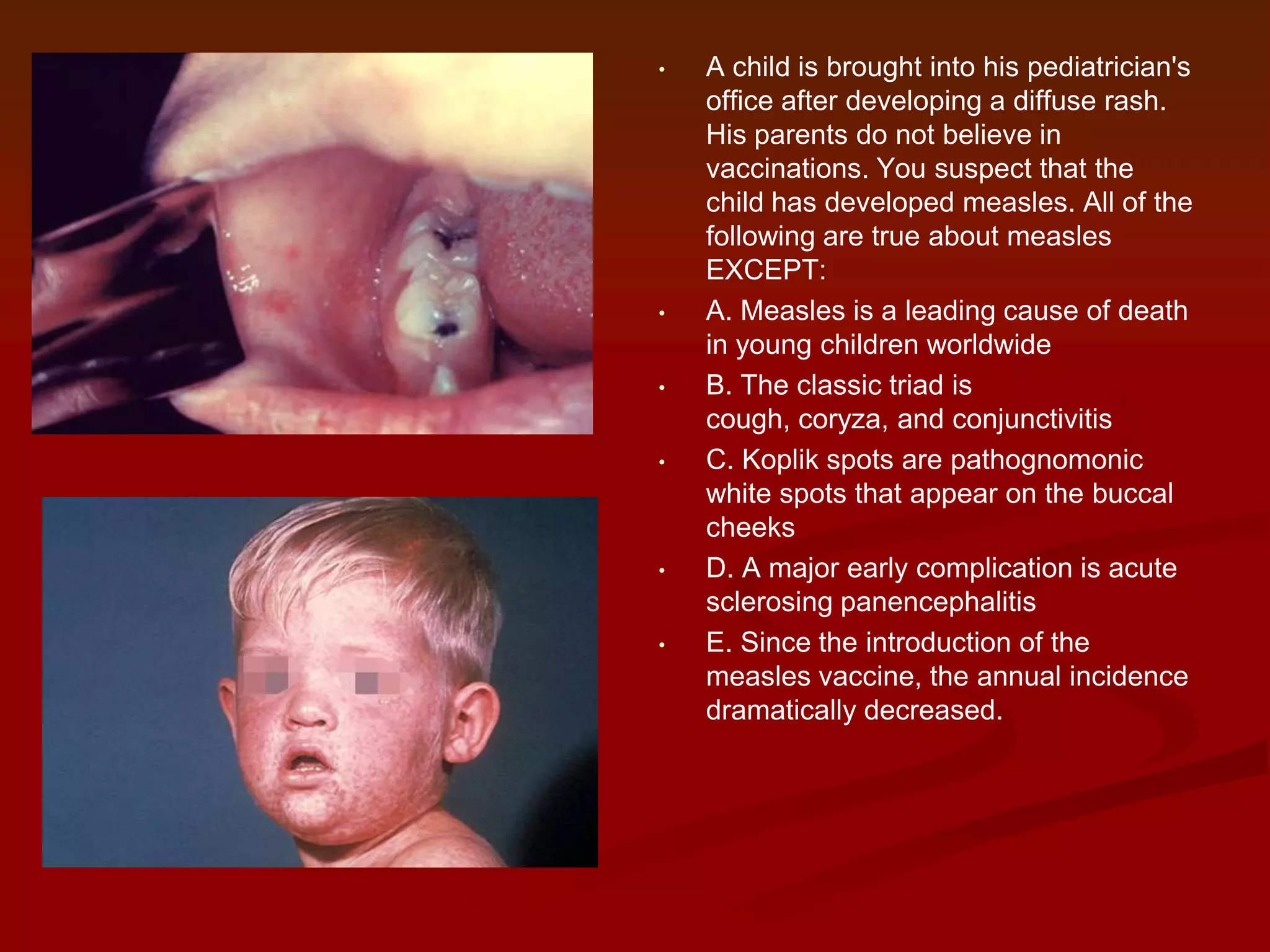 •

•

•

•

•

•

A child is brought into his pediatrician's
office after developing a diffuse rash.
His parents do not believe in
vaccinations. You suspect that the
child has developed measles. All of the
following are true about measles
EXCEPT:
A. Measles is a leading cause of death
in young children worldwide
B. The classic triad is
cough, coryza, and conjunctivitis
C. Koplik spots are pathognomonic
white spots that appear on the buccal
cheeks
D. A major early complication is acute
sclerosing panencephalitis
E. Since the introduction of the
measles vaccine, the annual incidence
dramatically decreased.

 