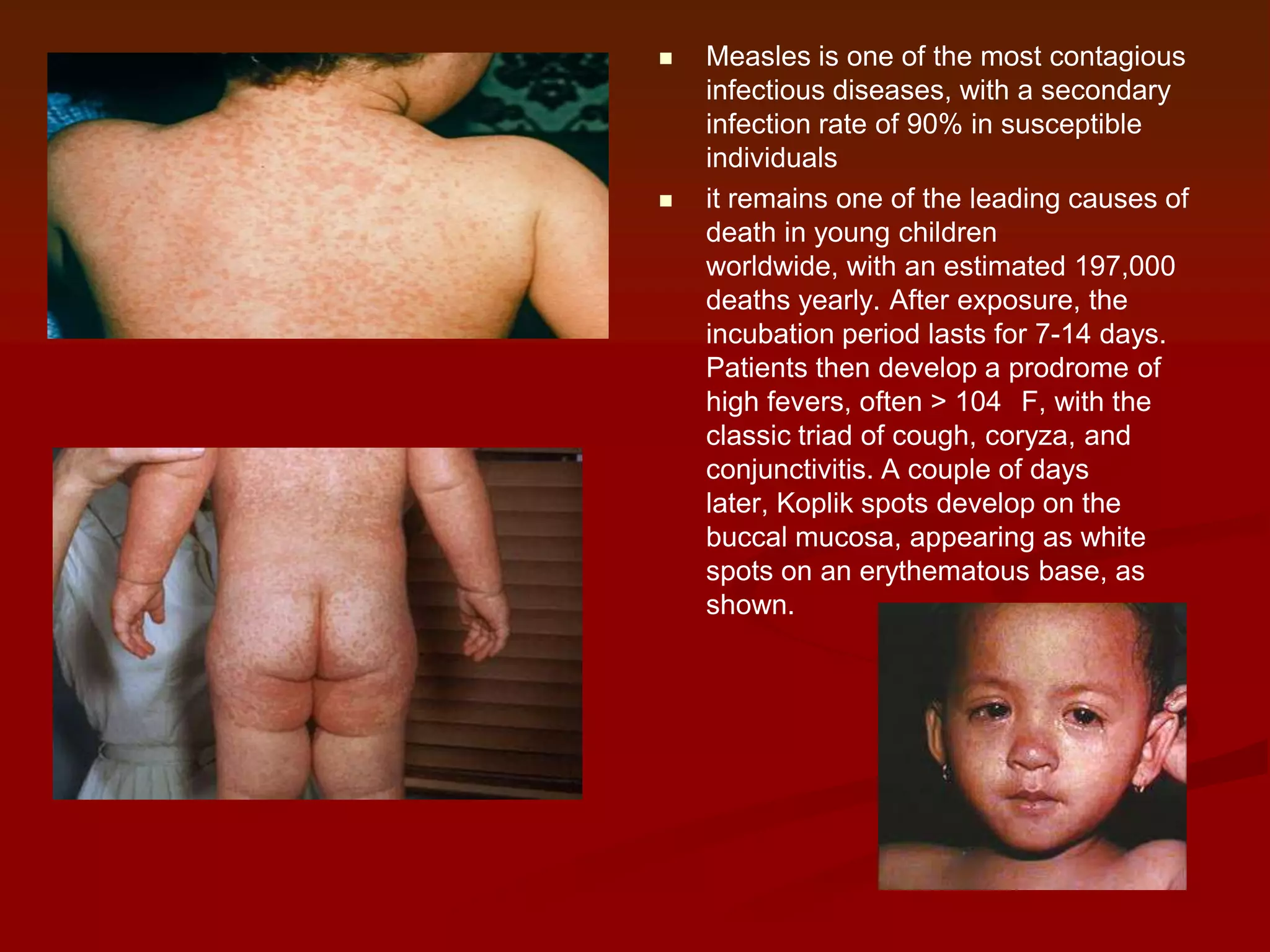 



Measles is one of the most contagious
infectious diseases, with a secondary
infection rate of 90% in susceptible
individuals
it remains one of the leading causes of
death in young children
worldwide, with an estimated 197,000
deaths yearly. After exposure, the
incubation period lasts for 7-14 days.
Patients then develop a prodrome of
high fevers, often > 104 F, with the
classic triad of cough, coryza, and
conjunctivitis. A couple of days
later, Koplik spots develop on the
buccal mucosa, appearing as white
spots on an erythematous base, as
shown.

 