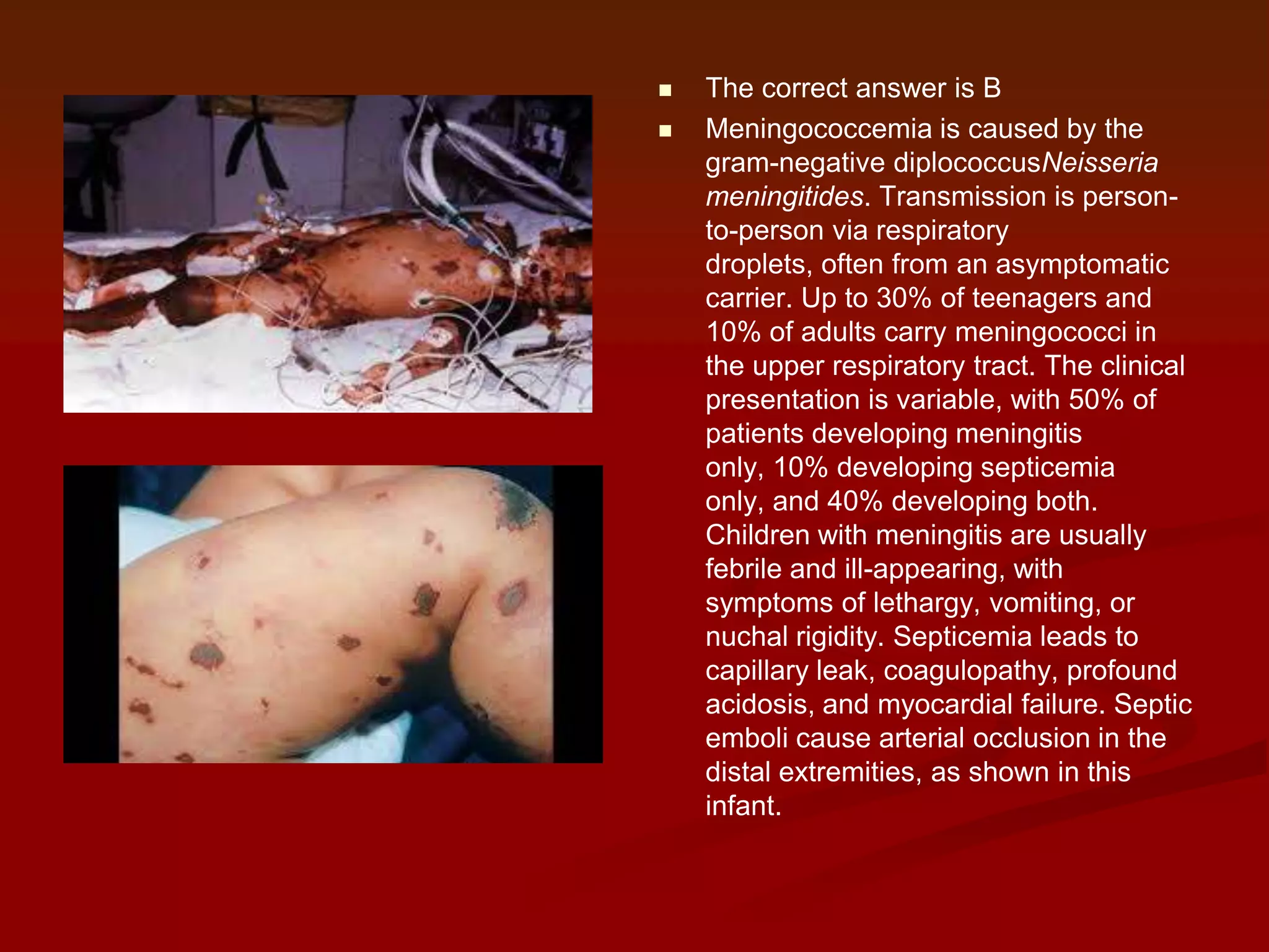 


The correct answer is B
Meningococcemia is caused by the
gram-negative diplococcusNeisseria
meningitides. Transmission is personto-person via respiratory
droplets, often from an asymptomatic
carrier. Up to 30% of teenagers and
10% of adults carry meningococci in
the upper respiratory tract. The clinical
presentation is variable, with 50% of
patients developing meningitis
only, 10% developing septicemia
only, and 40% developing both.
Children with meningitis are usually
febrile and ill-appearing, with
symptoms of lethargy, vomiting, or
nuchal rigidity. Septicemia leads to
capillary leak, coagulopathy, profound
acidosis, and myocardial failure. Septic
emboli cause arterial occlusion in the
distal extremities, as shown in this
infant.

 