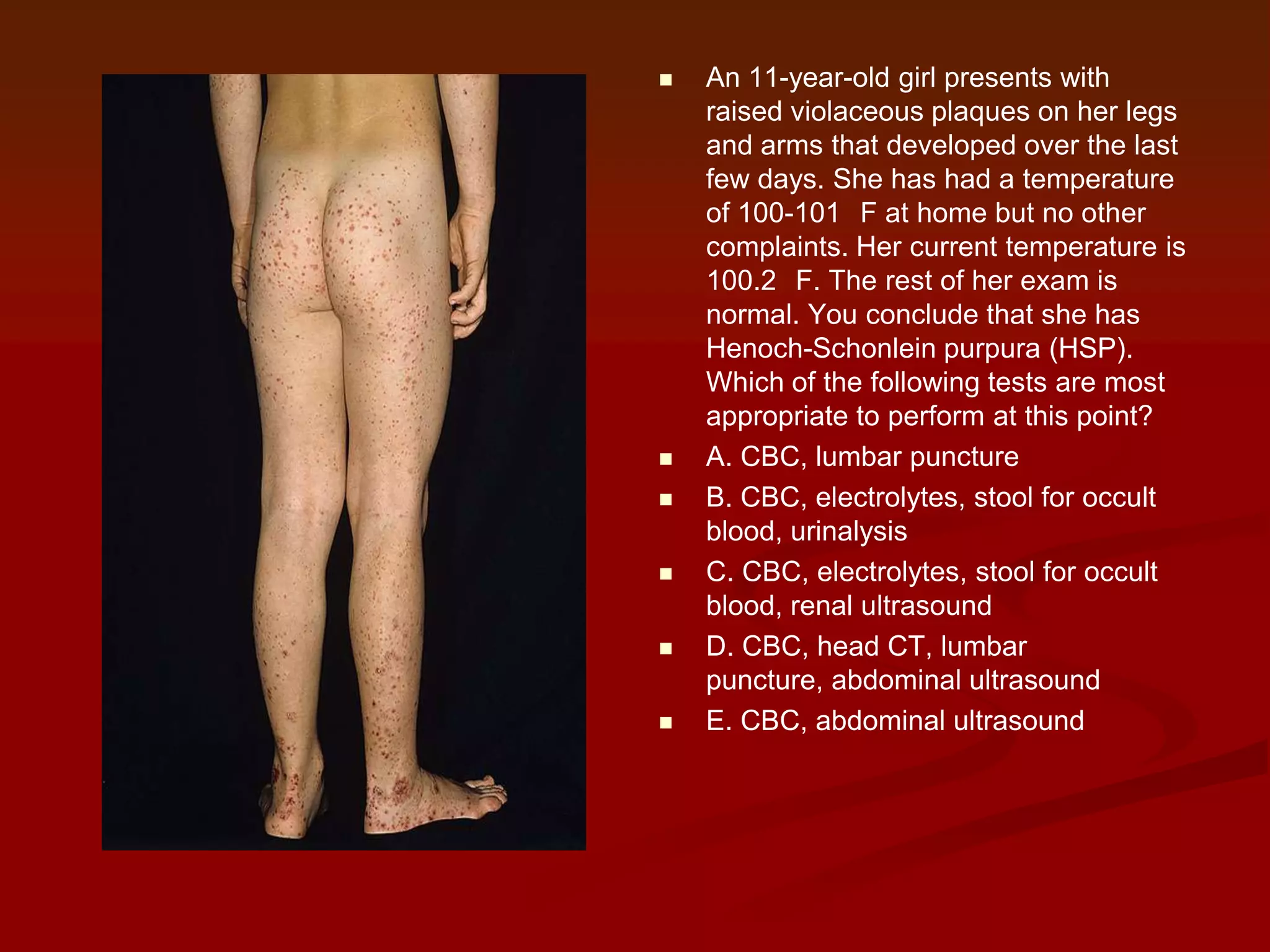 










An 11-year-old girl presents with
raised violaceous plaques on her legs
and arms that developed over the last
few days. She has had a temperature
of 100-101 F at home but no other
complaints. Her current temperature is
100.2 F. The rest of her exam is
normal. You conclude that she has
Henoch-Schonlein purpura (HSP).
Which of the following tests are most
appropriate to perform at this point?
A. CBC, lumbar puncture
B. CBC, electrolytes, stool for occult
blood, urinalysis
C. CBC, electrolytes, stool for occult
blood, renal ultrasound
D. CBC, head CT, lumbar
puncture, abdominal ultrasound
E. CBC, abdominal ultrasound

 