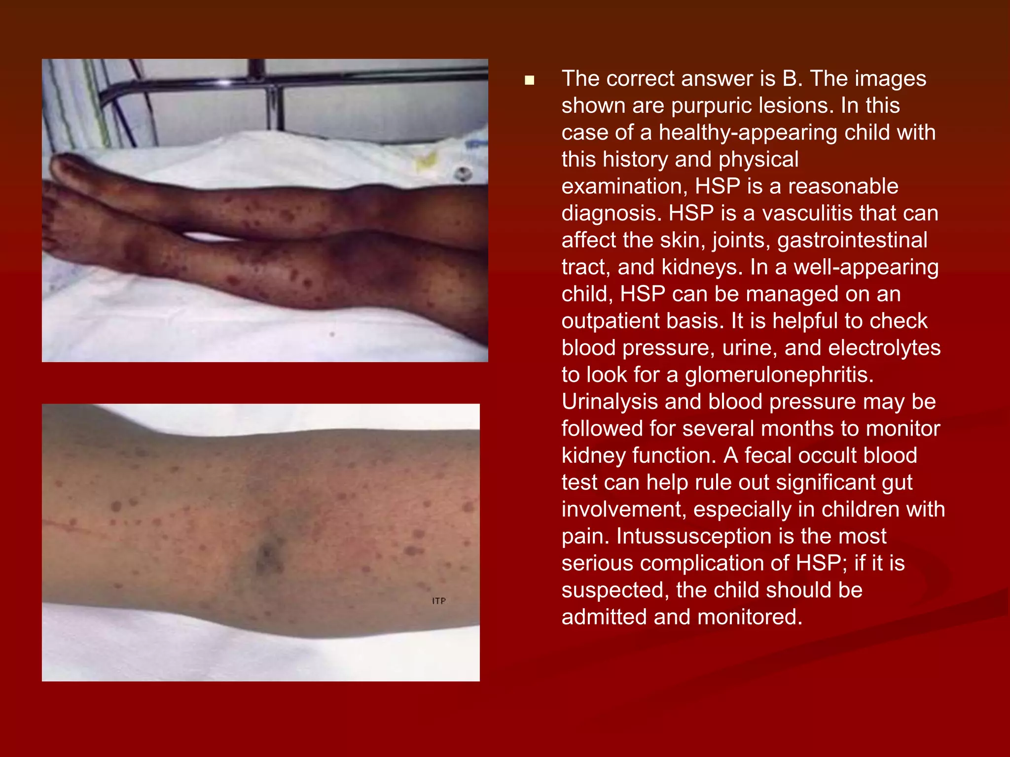 

The correct answer is B. The images
shown are purpuric lesions. In this
case of a healthy-appearing child with
this history and physical
examination, HSP is a reasonable
diagnosis. HSP is a vasculitis that can
affect the skin, joints, gastrointestinal
tract, and kidneys. In a well-appearing
child, HSP can be managed on an
outpatient basis. It is helpful to check
blood pressure, urine, and electrolytes
to look for a glomerulonephritis.
Urinalysis and blood pressure may be
followed for several months to monitor
kidney function. A fecal occult blood
test can help rule out significant gut
involvement, especially in children with
pain. Intussusception is the most
serious complication of HSP; if it is
suspected, the child should be
admitted and monitored.

 