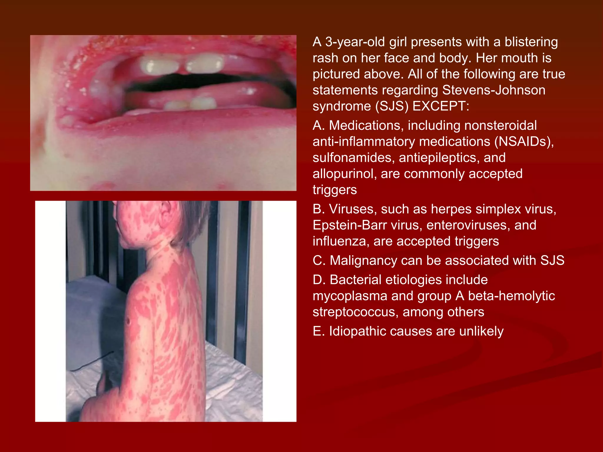A 3-year-old girl presents with a blistering
rash on her face and body. Her mouth is
pictured above. All of the following are true
statements regarding Stevens-Johnson
syndrome (SJS) EXCEPT:
A. Medications, including nonsteroidal
anti-inflammatory medications (NSAIDs),
sulfonamides, antiepileptics, and
allopurinol, are commonly accepted
triggers
B. Viruses, such as herpes simplex virus,
Epstein-Barr virus, enteroviruses, and
influenza, are accepted triggers
C. Malignancy can be associated with SJS
D. Bacterial etiologies include
mycoplasma and group A beta-hemolytic
streptococcus, among others
E. Idiopathic causes are unlikely

 