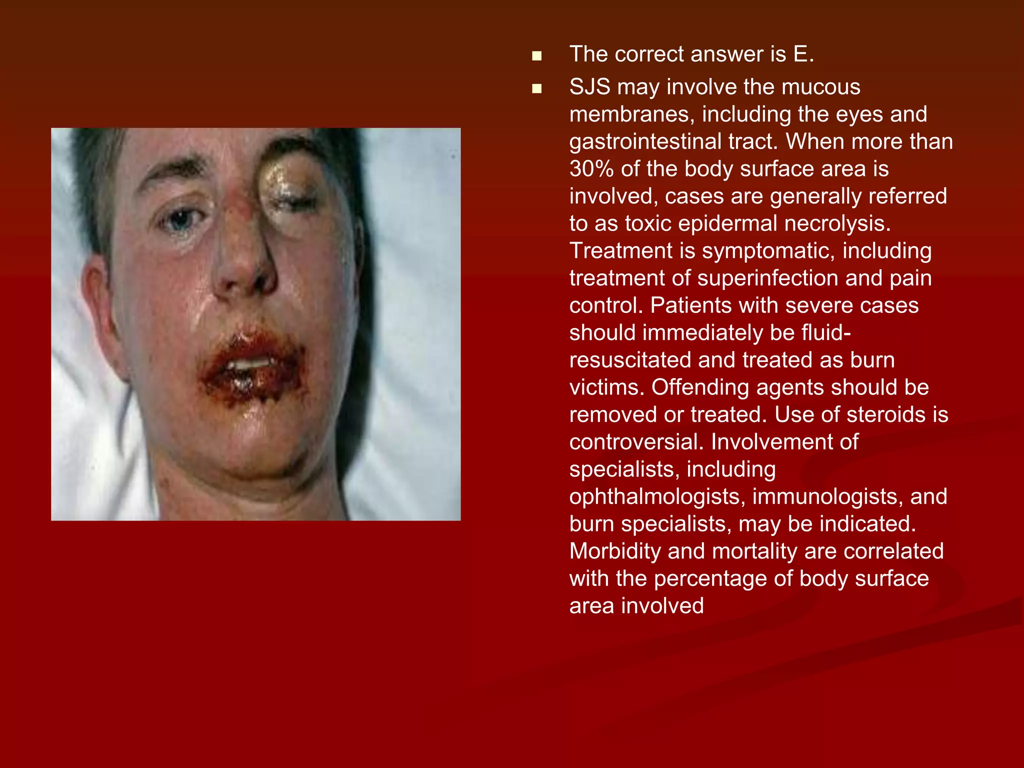 


The correct answer is E.
SJS may involve the mucous
membranes, including the eyes and
gastrointestinal tract. When more than
30% of the body surface area is
involved, cases are generally referred
to as toxic epidermal necrolysis.
Treatment is symptomatic, including
treatment of superinfection and pain
control. Patients with severe cases
should immediately be fluidresuscitated and treated as burn
victims. Offending agents should be
removed or treated. Use of steroids is
controversial. Involvement of
specialists, including
ophthalmologists, immunologists, and
burn specialists, may be indicated.
Morbidity and mortality are correlated
with the percentage of body surface
area involved

 