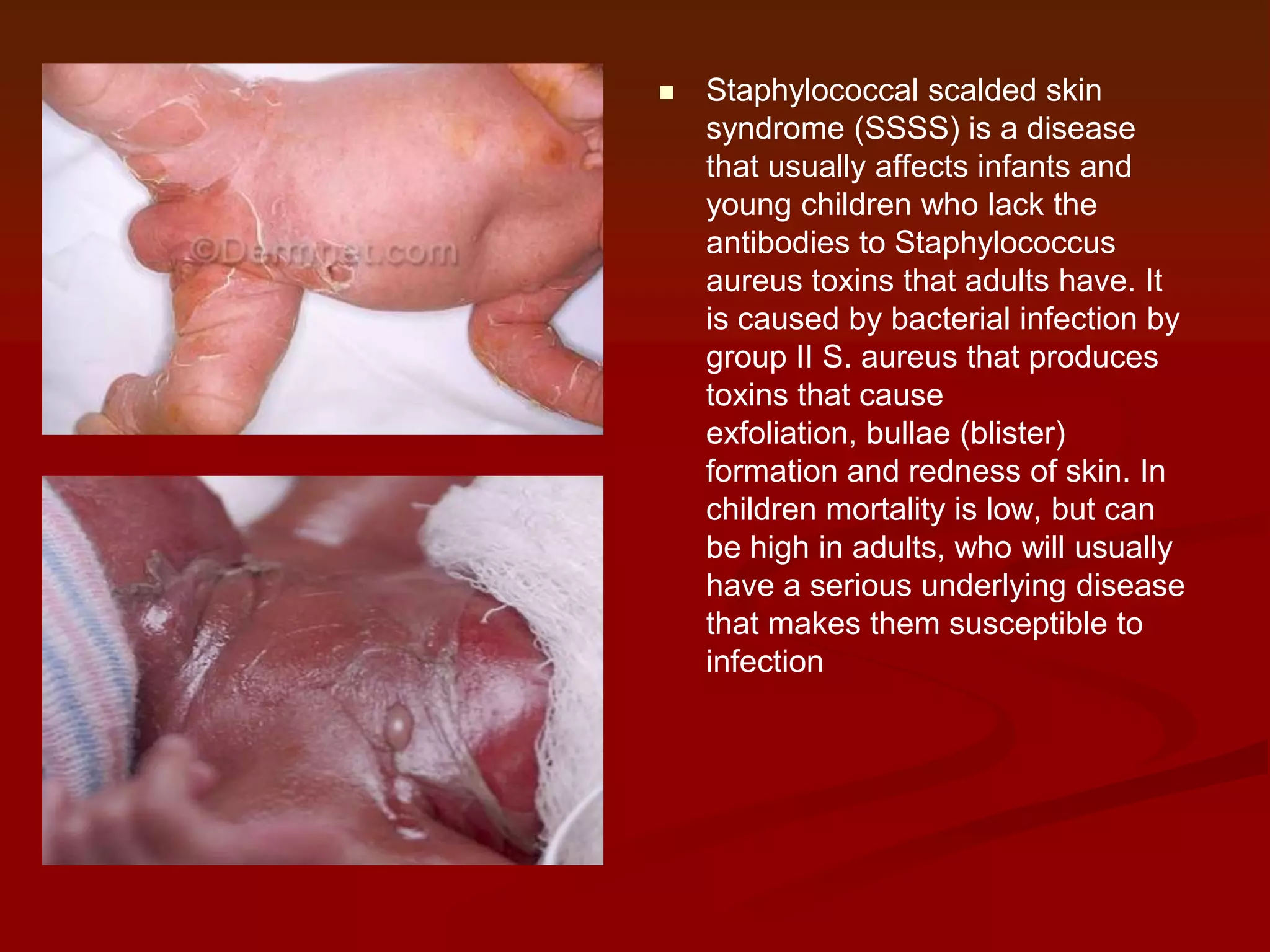

Staphylococcal scalded skin
syndrome (SSSS) is a disease
that usually affects infants and
young children who lack the
antibodies to Staphylococcus
aureus toxins that adults have. It
is caused by bacterial infection by
group II S. aureus that produces
toxins that cause
exfoliation, bullae (blister)
formation and redness of skin. In
children mortality is low, but can
be high in adults, who will usually
have a serious underlying disease
that makes them susceptible to
infection

 