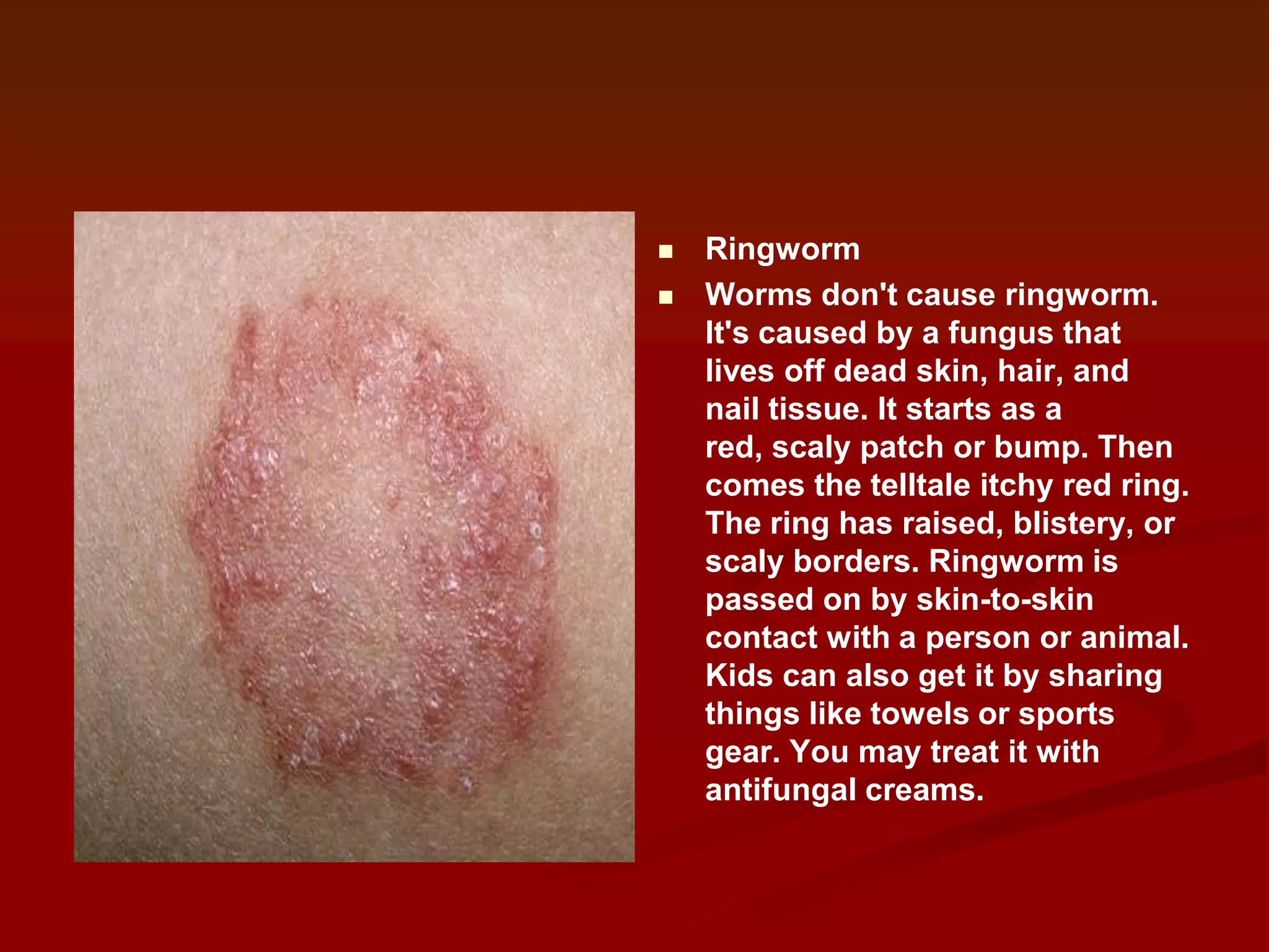 


Ringworm
Worms don't cause ringworm.
It's caused by a fungus that
lives off dead skin, hair, and
nail tissue. It starts as a
red, scaly patch or bump. Then
comes the telltale itchy red ring.
The ring has raised, blistery, or
scaly borders. Ringworm is
passed on by skin-to-skin
contact with a person or animal.
Kids can also get it by sharing
things like towels or sports
gear. You may treat it with
antifungal creams.

 